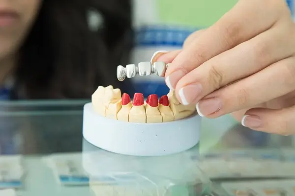 Dental Bridges