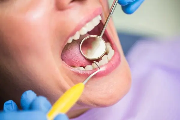 Tooth Restoration
