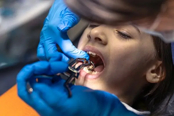 Dental Sealants