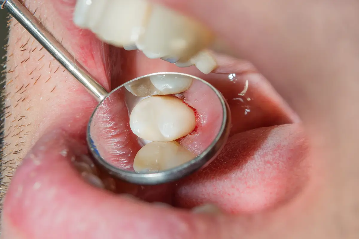 Sealing the Tooth