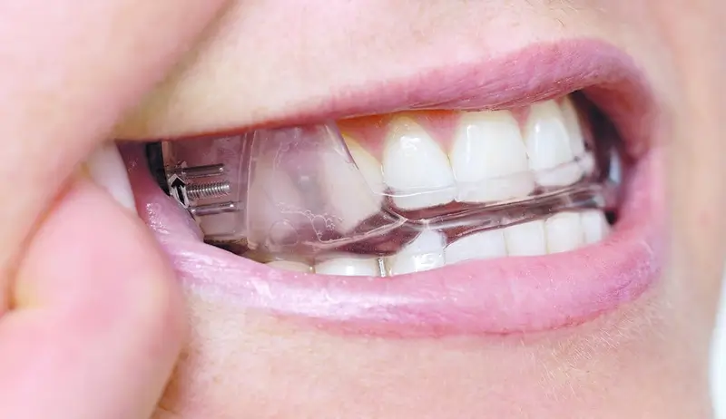 Dental Sleep Appliances in Bunbury