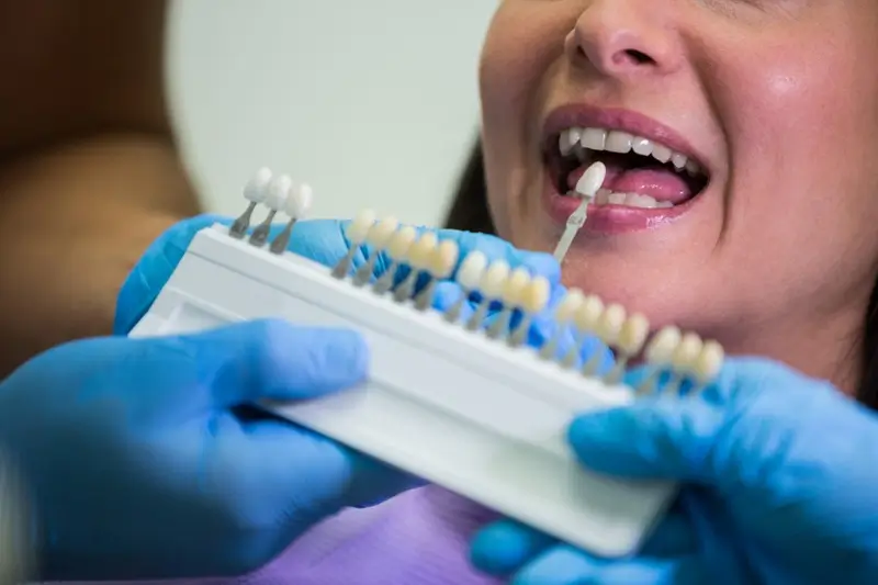 Veneers for Stained Teeth