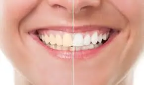 Whitening Maintenance