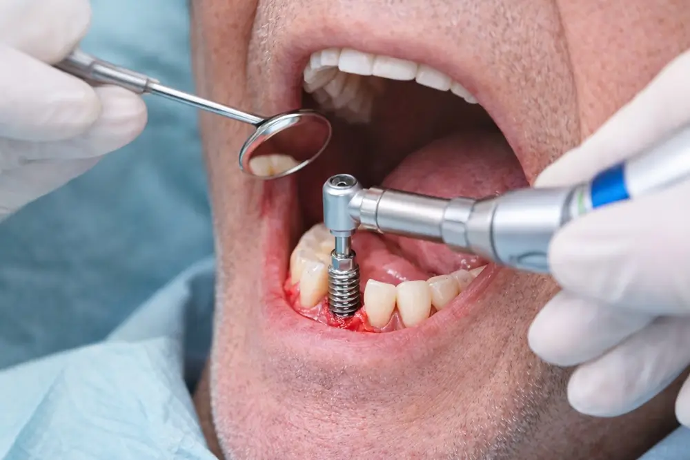 Dental Implants