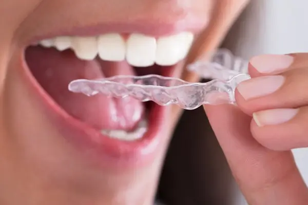 Night Guard (Bruxism) Treatment