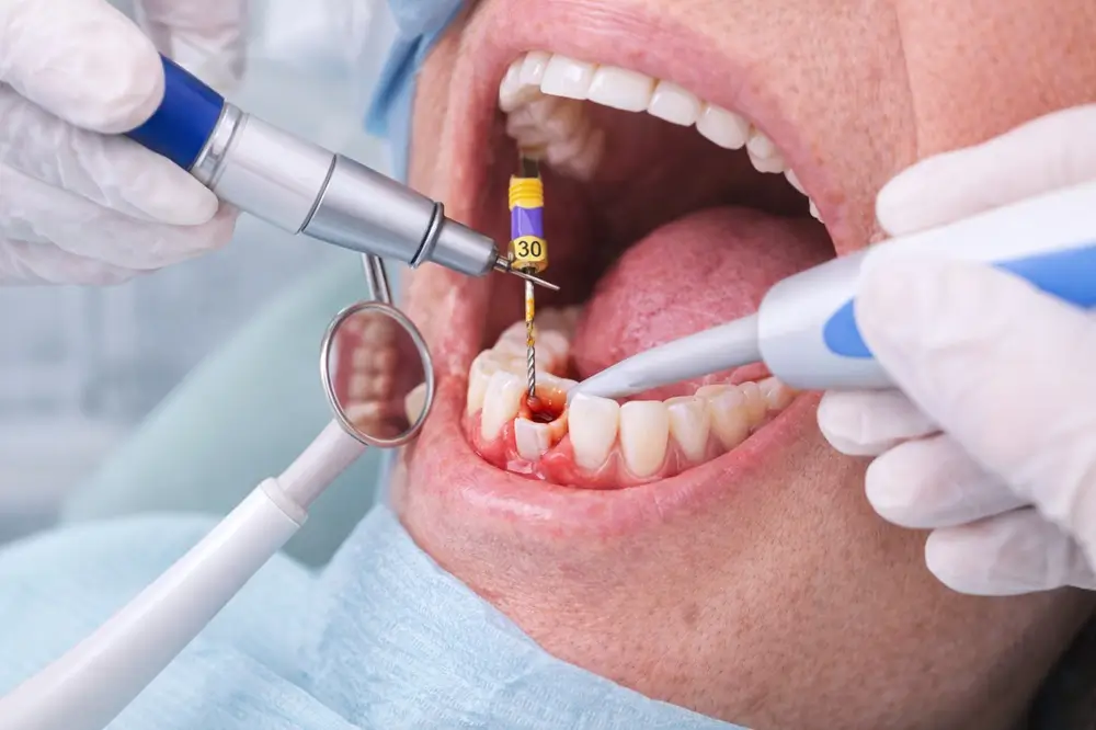 Root Canal Treatment